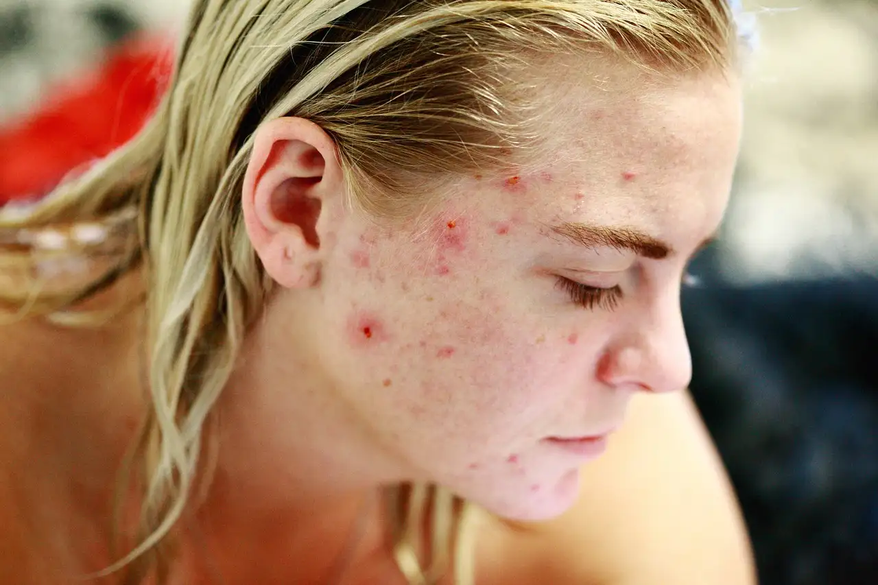 Come prevenire l'acne e migliorare la salute della pelle?